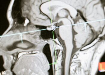 Cognitive Crossroads: Exploring The Impact Of Brain Injuries On Cognitive Functioning