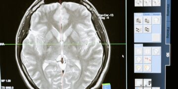 How To Seek Compensation for Brain Injury After an Accident